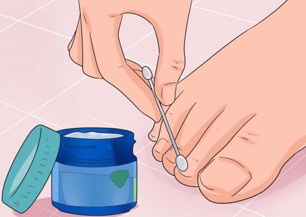 ointment application for the treatment of nail fungus