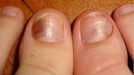 A sign of ringworm is the darkening of the nail plate