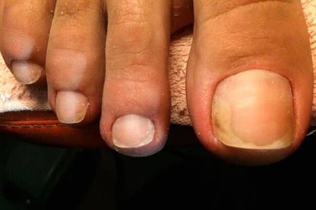 Nail fungus starts in the big toe
