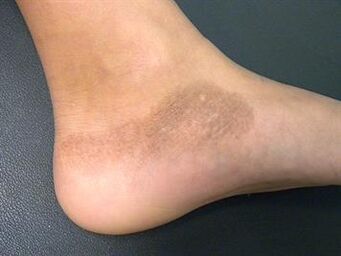 Foot mycosis is accompanied by a change in skin tone