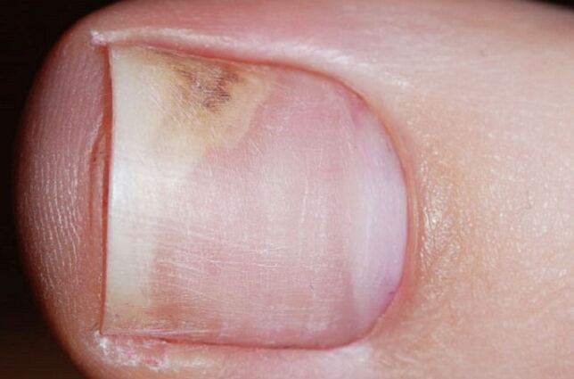 Signs of onychomycosis in the initial phase - lack of shine, gap between the nail and the bed