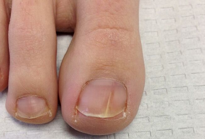 Visual manifestations of nail fungus in the initial stage
