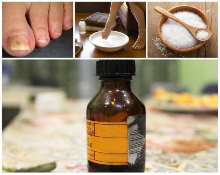 recipes with iodine to relieve ringworm