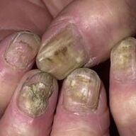 Fungus ran