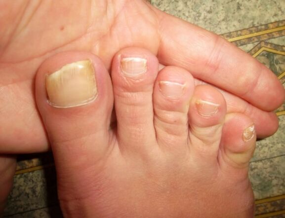 Fungus in a large nail