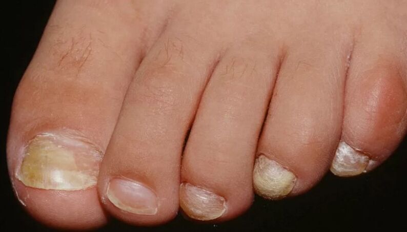 The nail fungus on the thumb