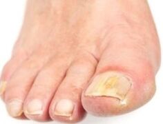 After bathing, the affected nail is easier to remove