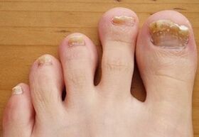 Executed Onychomicosis