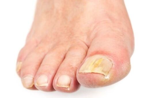 Nail fungus