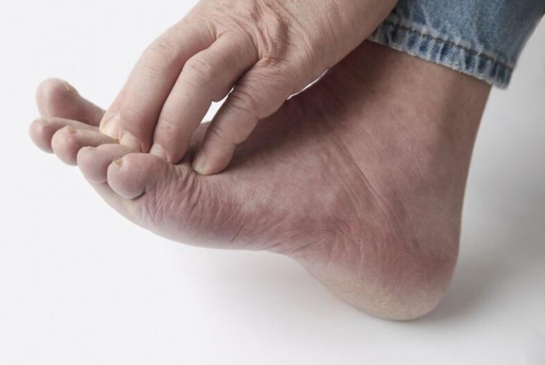 Foot fungus