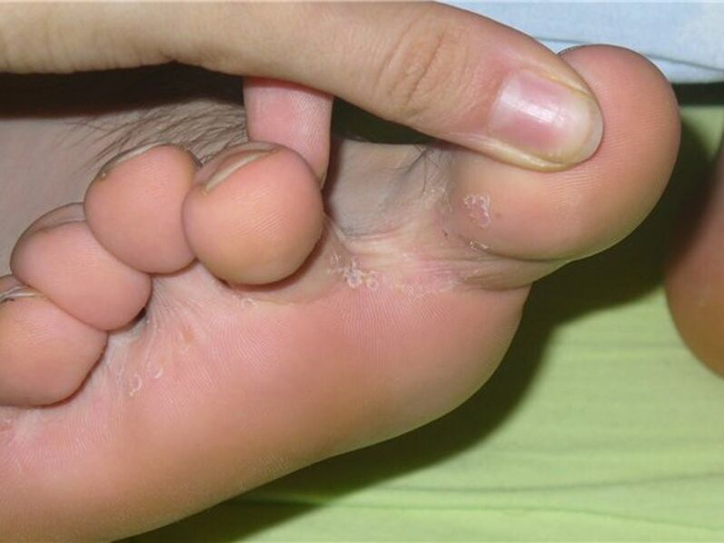 The fungus between the fingers