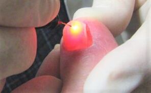Nail fungus treatment with a laser