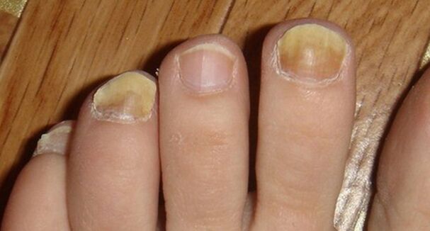 Changing the color and structure of nails