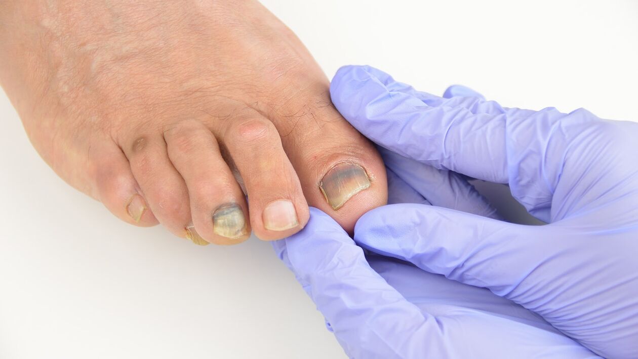 Foot fungus inspection