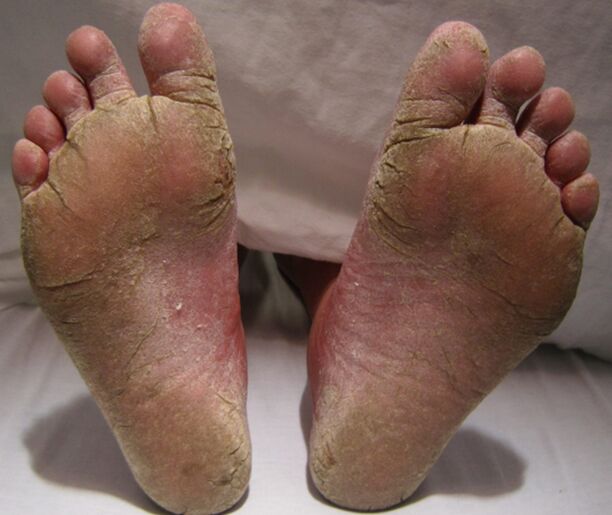 Mycotic defeat of the feet