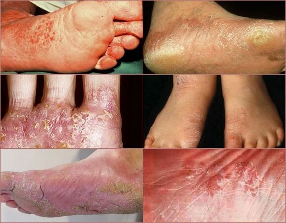 Dishydrotic stage
