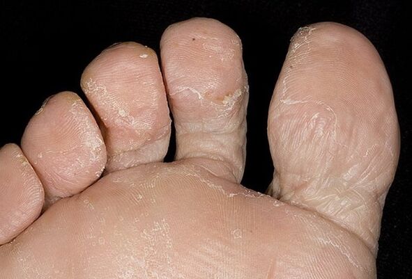 Leg fungus types