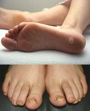 The fungus on the legs