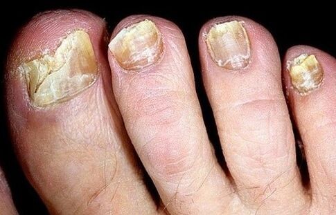 Nails collapse from the fungus