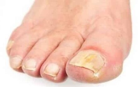 The early stage of the fungus on the nail