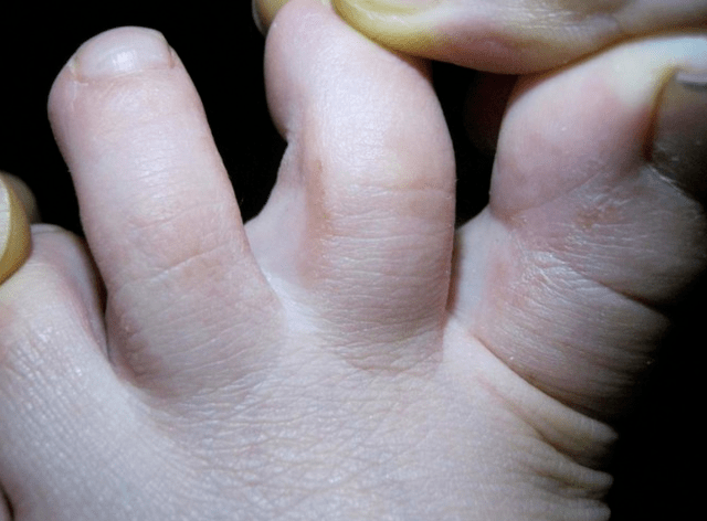 Ringworm in children