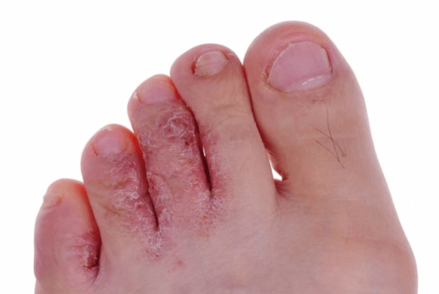 The advanced stage of ringworm