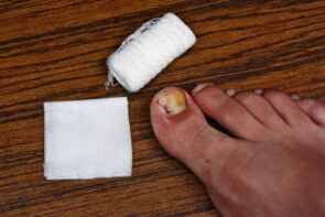 Compress with apple vinegar for fungal treatment