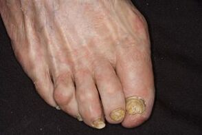 Treatment of nail fungus in the legs apple vinegar