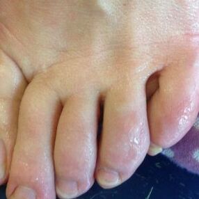forms of fungal infection