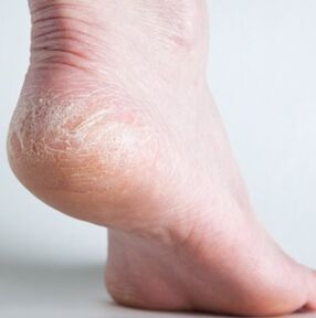 nail fungus diagnosis