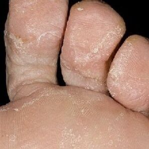 nail fungus stages