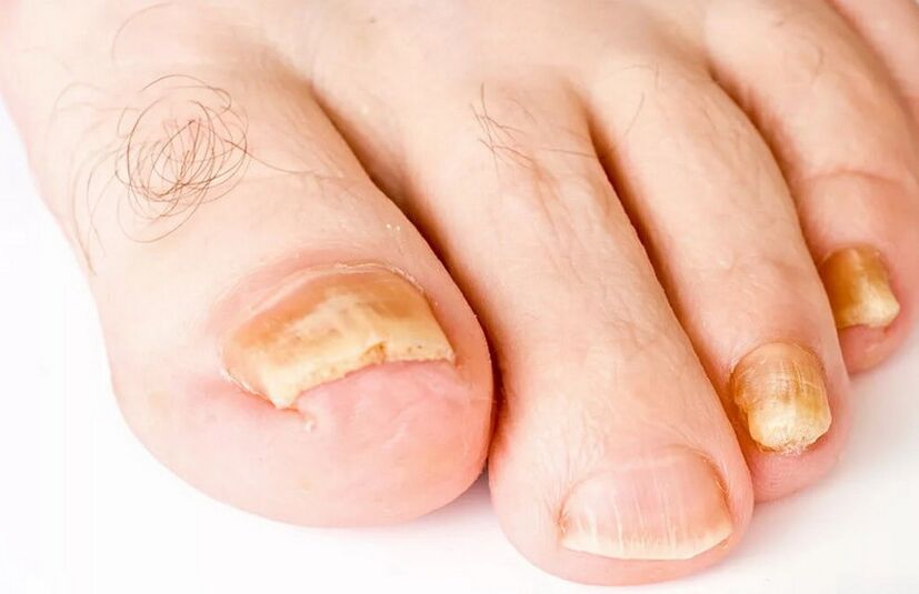 nail fungus