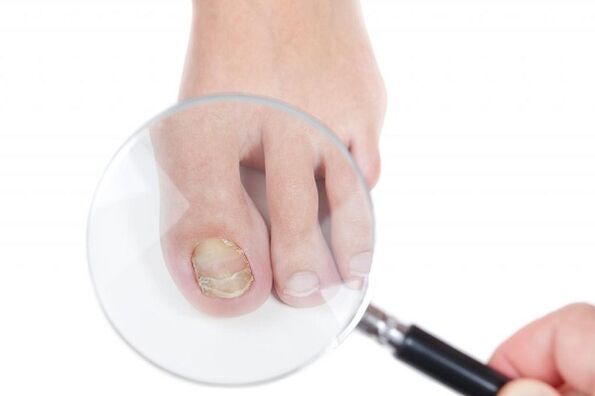 stages and stages of development of toenail fungus