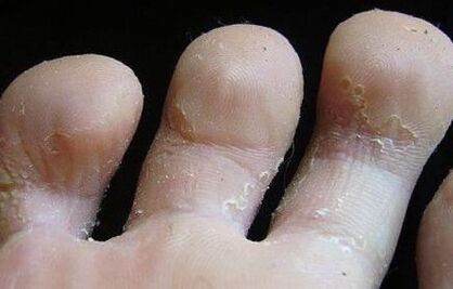 signs of fungus between toes
