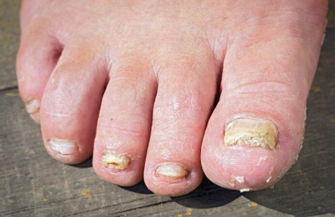 Rubromycosis fungus on feet