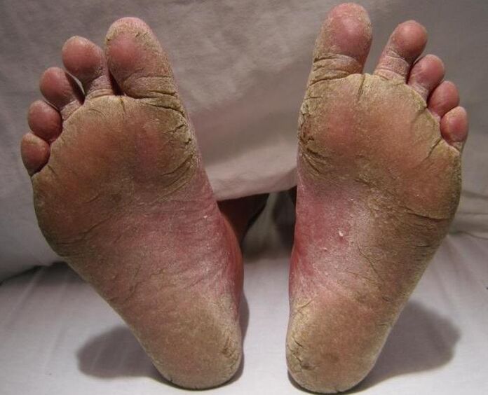 scaly-hyperkeratic fungus on legs