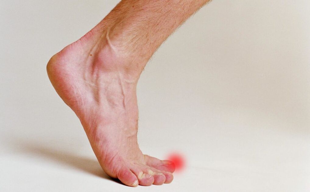 Fungus on big toe nails