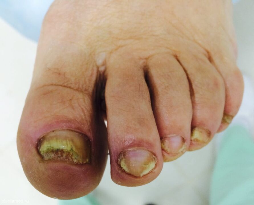 Severe deformation of toenails is a sign of advanced third stage of the fungus