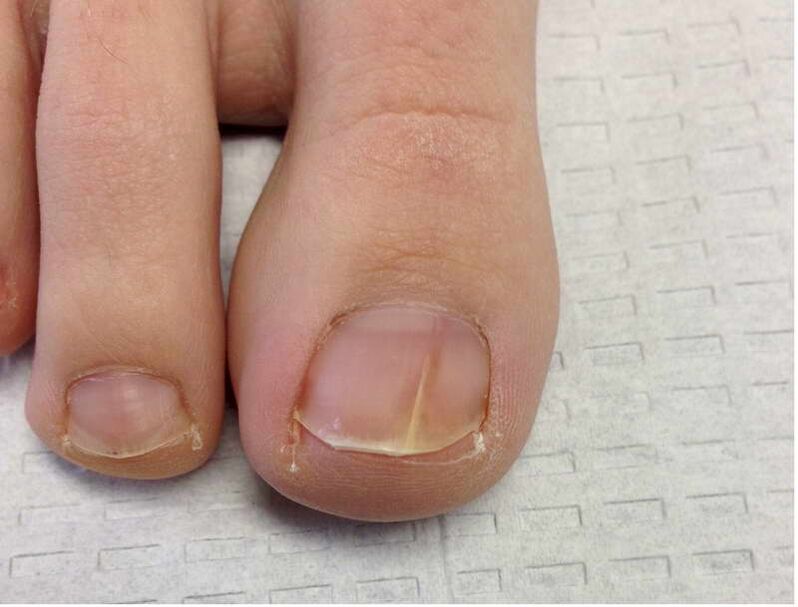 Stripes and spots on the big toe nail during the first stage of fungus development