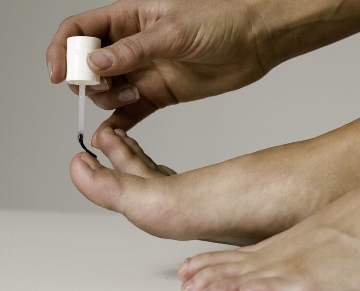 The use of medicinal varnish for the treatment and prevention of onychomycosis in the big toe