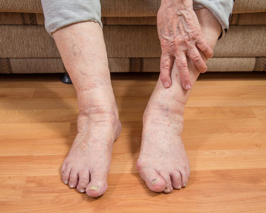 To prevent the spread of fungal microspores, do not walk barefoot at home.